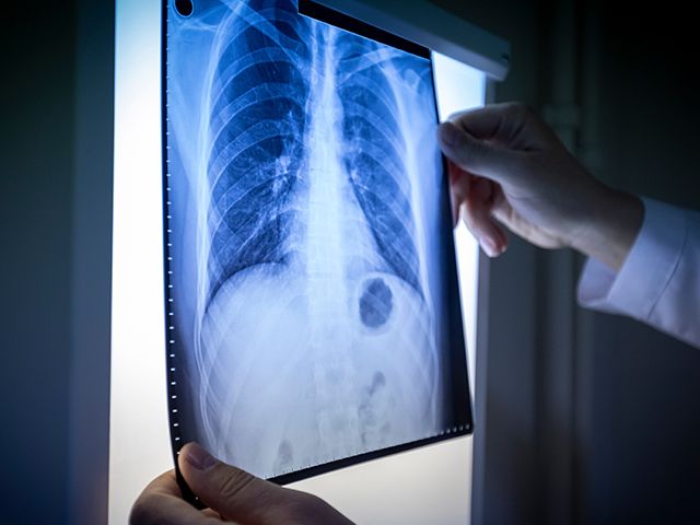 Lung xray